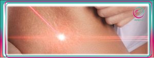 درمان ترک پوستی با لیزر